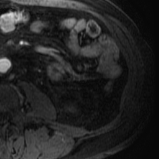 File:Atypical renal cyst on MRI (Radiopaedia 17349-17046 C 31).jpg
