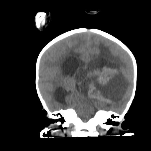 Atypical teratoid rhabdoid tumor (AT-RT) (Radiopaedia 85823-101654 Coronal non-contrast 30).jpg