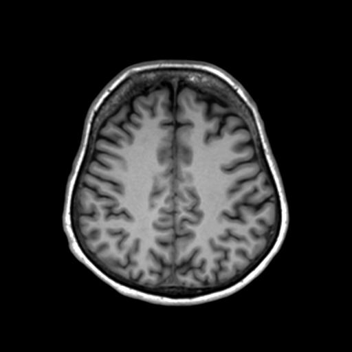 Autoimmune limbic encephalitis (Radiopaedia 30363-31005 T1 Axial 3mm 36).jpg