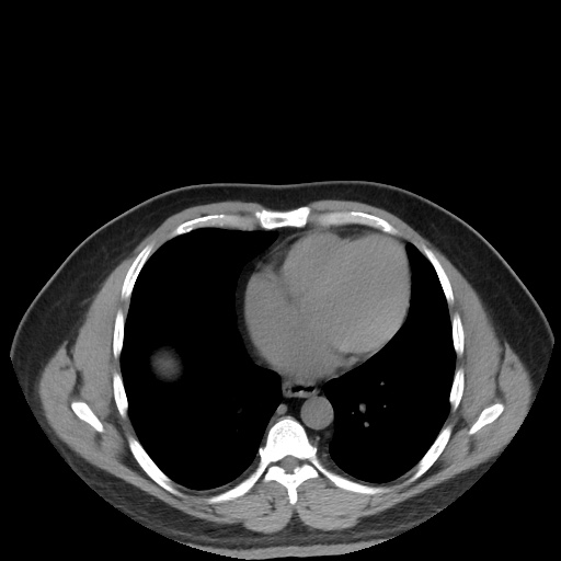 File:Autosomal dominant polycystic kidney disease (Radiopaedia 50259-55612 Axial non-contrast 8).jpg