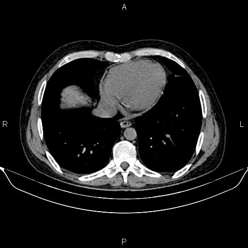 Autosomal dominant polycystic kidney disease (Radiopaedia 87830-104287 Axial non-contrast 6).jpg