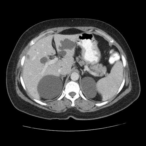 File:Autosomal dominant polycystic kidney disease with hepatic involvement (Radiopaedia 32693-33662 B 18).jpg