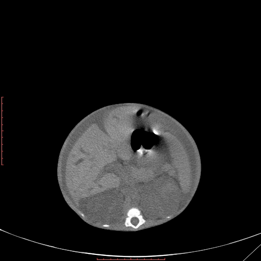 Autosomal recessive polycystic kidney disease associated with Caroli disease (Radiopaedia 61932-69984 Axial non-contrast 173).jpg