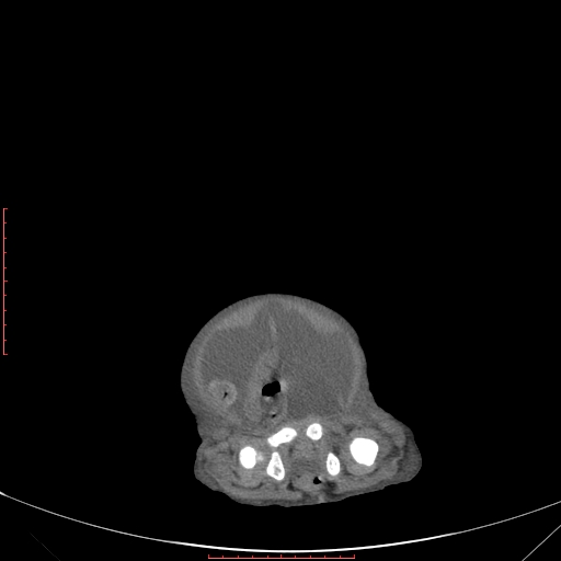 Autosomal recessive polycystic kidney disease associated with Caroli disease (Radiopaedia 61932-69984 B 342).jpg
