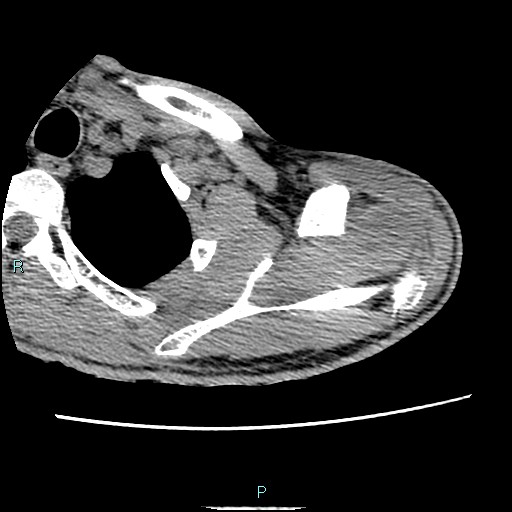 File:Avascular necrosis after fracture dislocations of the proximal humerus (Radiopaedia 88078-104653 D 24).jpg