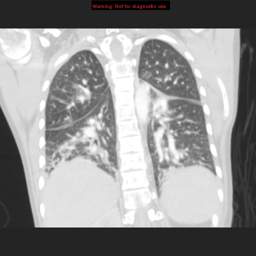 File:Avascular necrosis in sickle cell disease (Radiopaedia 17448-17152 B 89).jpg