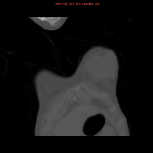 Avascular necrosis in sickle cell disease (Radiopaedia 17448-17152 Coronal bone window 6).jpg