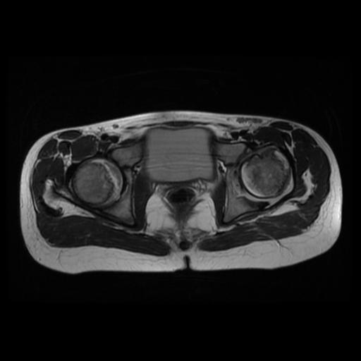 File:Avascular necrosis of the hip (Radiopaedia 29563-30067 Axial T2 8).jpg