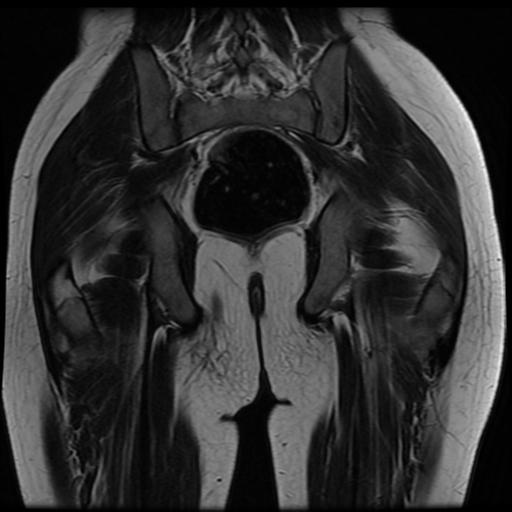 File:Avascular necrosis of the hip (Radiopaedia 29563-30067 Coronal T2 14).jpg