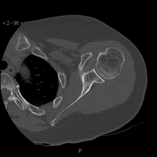 Avascular necrosis of the shoulder - Cruess stage I (Radiopaedia 77674-89887 Axial bone window 24).jpg