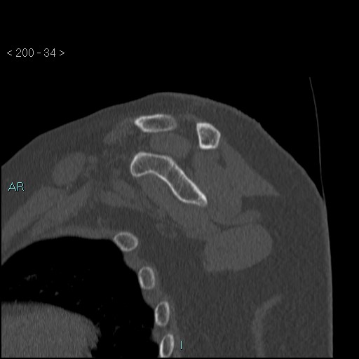 Avascular necrosis of the shoulder - Cruess stage I (Radiopaedia 77674-89887 Sagittal bone window 33).jpg