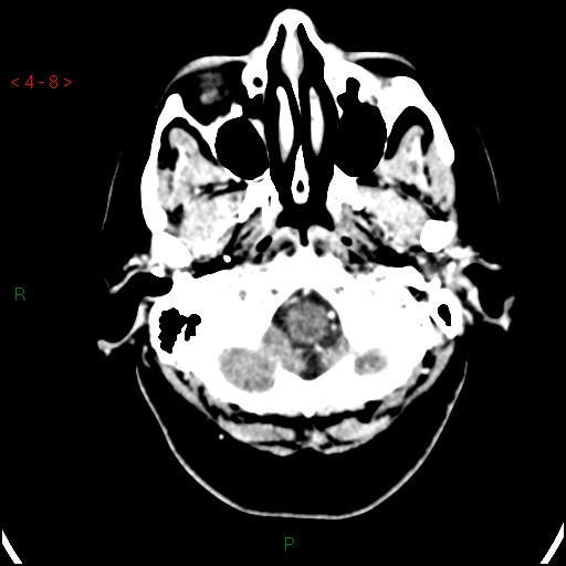 Azygos anterior cerebral artery (Radiopaedia 51987-57833 A 8).jpg