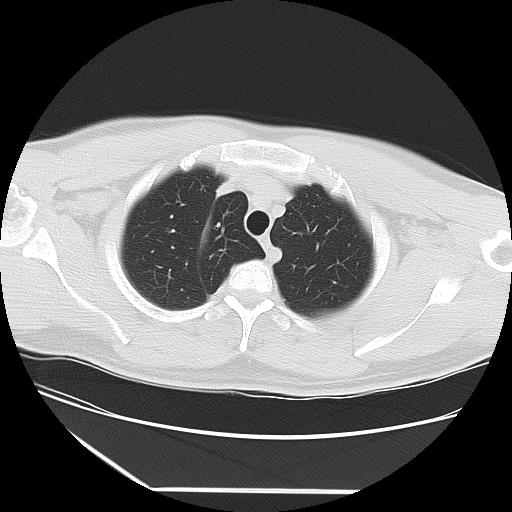 Azygos fissure (Radiopaedia 88181-104784 Axial lung window 8).jpg