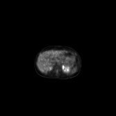 B-cell lymphoma of the mesentery (Radiopaedia 65743-74868 18F-FDG PET-CT 160).jpg