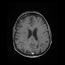 Balo concentric sclerosis (Radiopaedia 53875-59982 Axial LAVA C+ 171).jpg