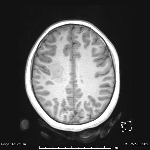 Balo concentric sclerosis (Radiopaedia 61637-69636 Axial T1 61).jpg
