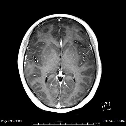 Balo concentric sclerosis (Radiopaedia 61637-69636 Axial T1 C+ 38).jpg