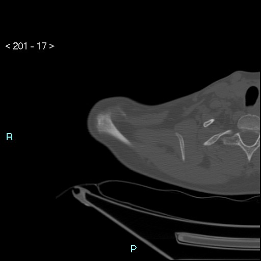 Bankart lesion with glenoid bone defect - assessment TC with PICO method (Radiopaedia 42855-93901 Axial bone window 16).jpg