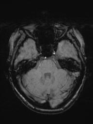 Base of skull chondrosarcoma (Radiopaedia 30410-31070 Axial SWI 17).jpg