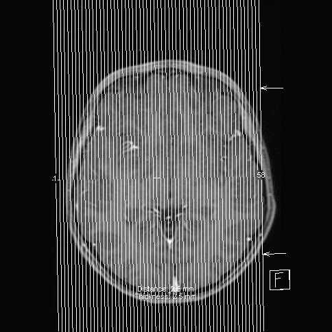 Base of skull rhabdomyosarcoma (Radiopaedia 32196-33142 J 59).jpg