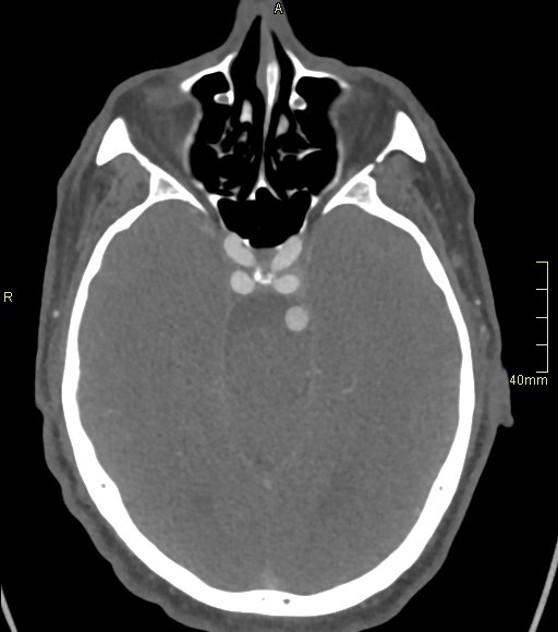 Basilar artery aneurysm (Radiopaedia 56261-62932 A 66).jpg