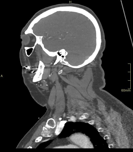 Basilar artery aneurysm (Radiopaedia 56261-62932 C 57).jpg