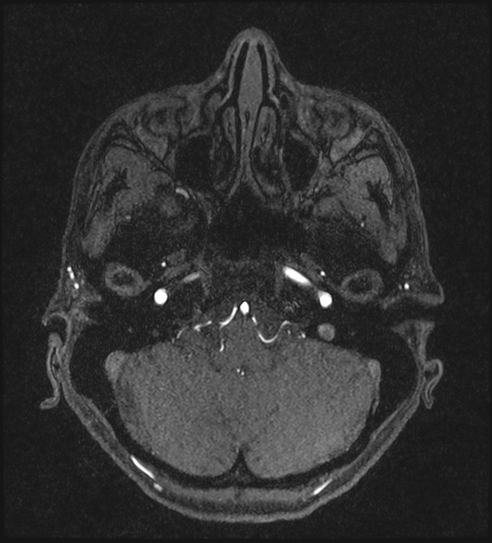 Basilar artery perforator aneurysm (Radiopaedia 82455-97733 Axial MRA 52).jpg