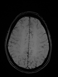 Basilar artery perforator aneurysm (Radiopaedia 82455-97733 Axial SWI 42).jpg