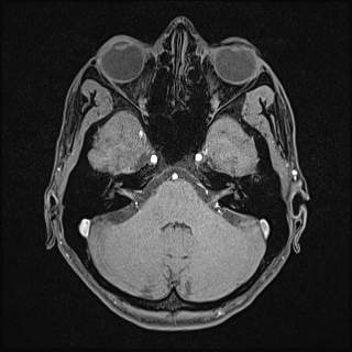 Basilar artery perforator aneurysm (Radiopaedia 82455-97733 Axial T1 fat sat 37).jpg