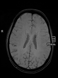 Basilar artery perforator aneurysm (Radiopaedia 82455-99523 Axial SWI 42).jpg