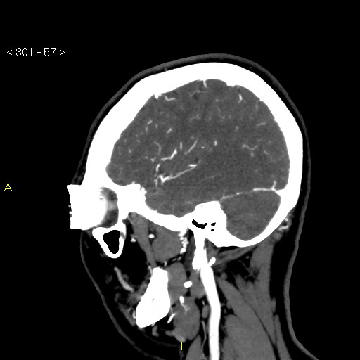 Basilar artery thrombosis (Radiopaedia 16260-15944 C 51).jpg