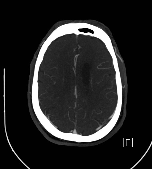 File:Basilar artery thrombosis (Radiopaedia 26986-27163 A 61).jpg