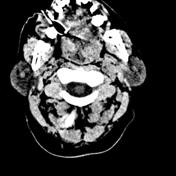 Basilar artery thrombosis (Radiopaedia 53351-59333 Axial non-contrast 10).jpg