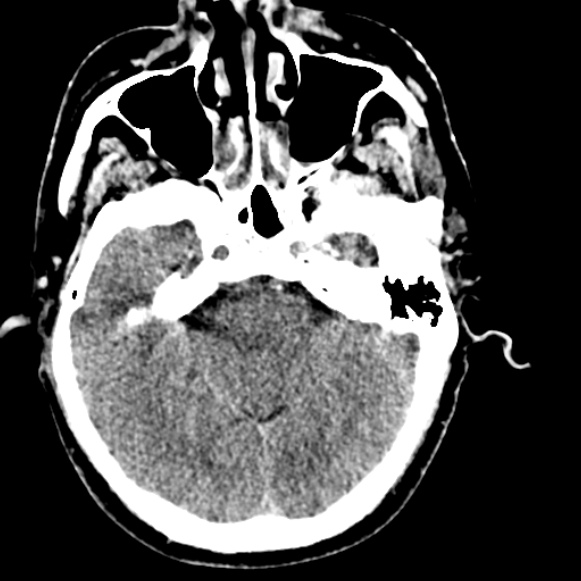 Basilar artery thrombosis (Radiopaedia 53351-59333 Axial non-contrast 44).jpg