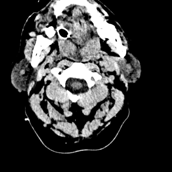 Basilar artery thrombosis (Radiopaedia 53351-59333 Axial non-contrast 5).jpg