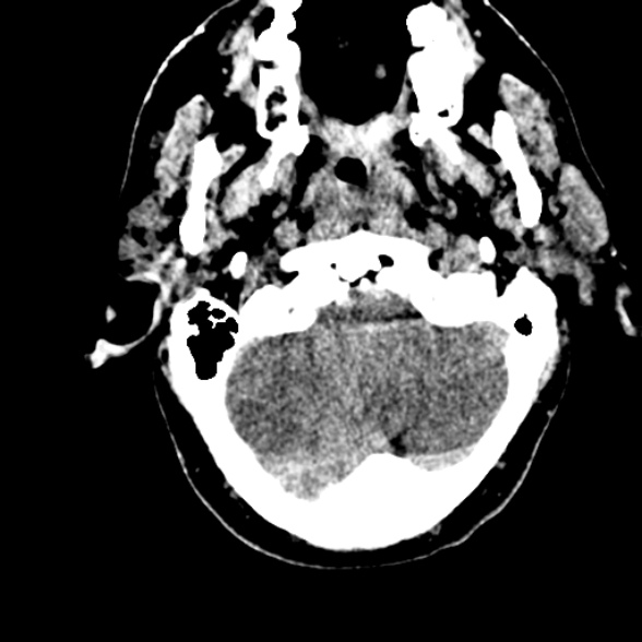 Basilar artery thrombosis (Radiopaedia 53351-59352 Axial non-contrast 23).jpg