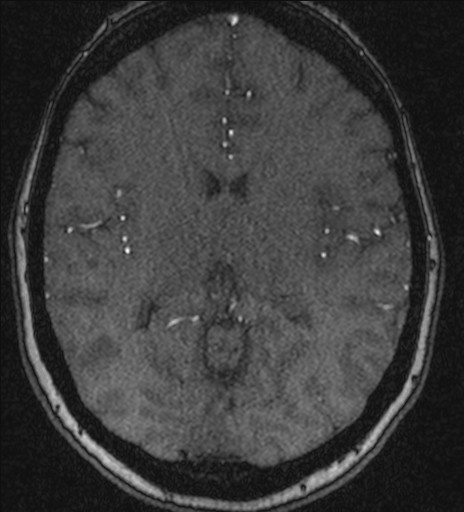 Basilar tip aneurysm (Radiopaedia 26504-26632 MRA 134).jpg