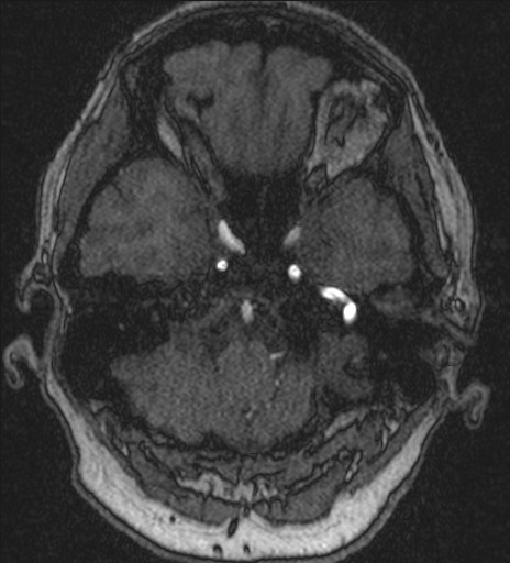 Basilar tip aneurysm (Radiopaedia 26504-26632 MRA 41).jpg