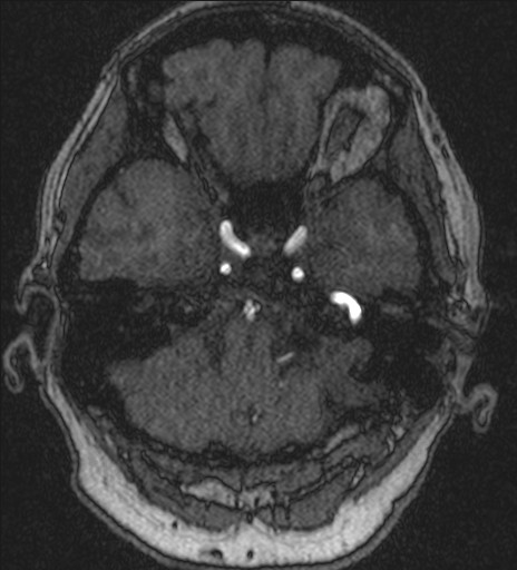 File:Basilar tip aneurysm (Radiopaedia 26504-26632 MRA 43).jpg