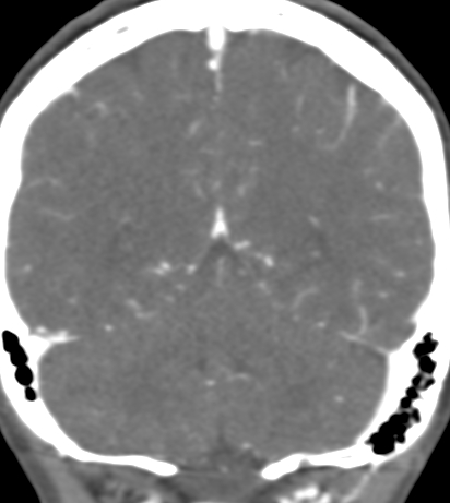 Basilar tip aneurysm with coiling (Radiopaedia 53912-60086 B 115).jpg