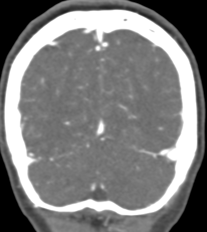 Basilar tip aneurysm with coiling (Radiopaedia 53912-60086 B 131).jpg
