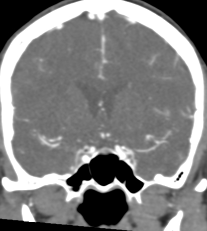 Basilar tip aneurysm with coiling (Radiopaedia 53912-60086 B 58).jpg