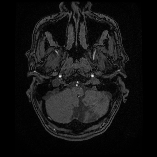 Basilar top and left middle cerebral artery aneurysm (Radiopaedia 61965-70031 Axial MRA 10).jpg