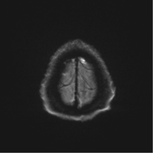 Behavioral variant frontotemporal dementia and late onset schizophrenia (Radiopaedia 52197-58083 Axial DTI Trace W 53).png