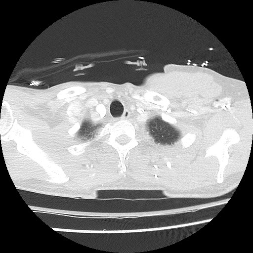 Benign post-traumatic pseudopneumoperitoneum (Radiopaedia 71199-81495 Axial lung window 15).jpg