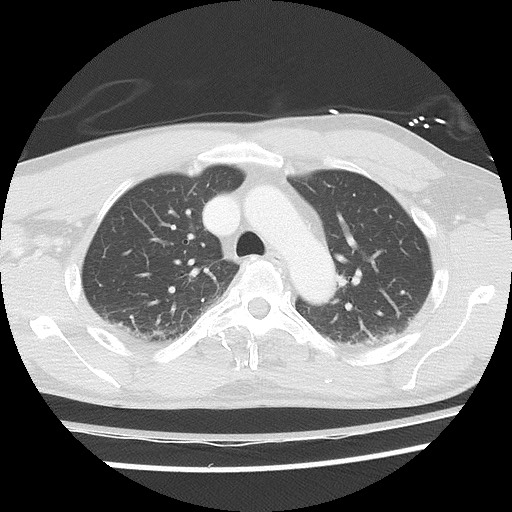 Benign post-traumatic pseudopneumoperitoneum (Radiopaedia 71199-81495 Axial lung window 27).jpg