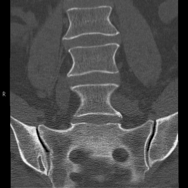 Bertolotti syndrome (Radiopaedia 24864-25128 Coronal bone window 15).jpg