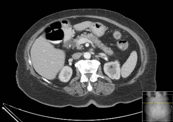 Bicameral celiacomesenteric aneurysm (Radiopaedia 55766-62327 A 23).jpg