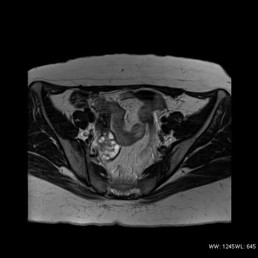 File:Bicornuate uterus- on MRI (Radiopaedia 49206-54297 Axial T2 4).jpg