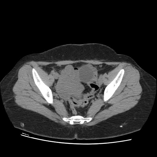 File:Bicornuate uterus (MRI) (Radiopaedia 49206-54296 Axial 9).jpg
